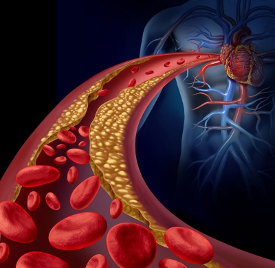 Atherosclerosis: Symptoms, Risk Factors, and Health Complications